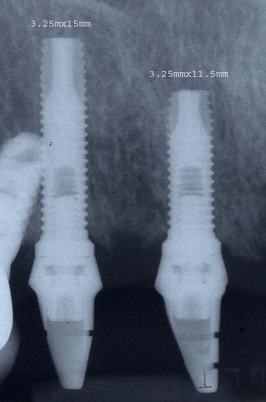 Biomet I Full Osseotite Parallel Walled Implant Dentaire Spotimplant