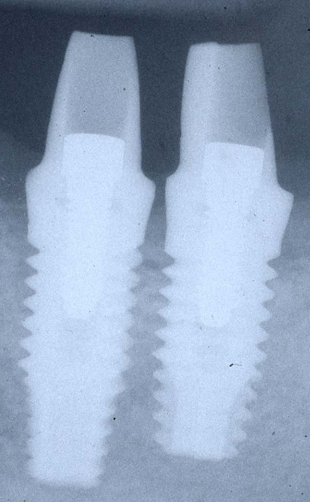 Biomet I Nanotite Parallel Walled Zahnimplantat Spotimplant