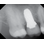 Champions Implants Biowin! image 1