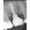 Altiva / Exactech NTR image 1