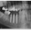 Timplant Nanoimplant image 1