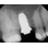 Champions Implants Biowin! image 2