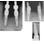 MIS Lance External hexagon image 9