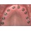 Nobel Biocare Branemark System MK III TiUnite image 1