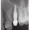 Champions Implants Square-Shaped-classic image 1