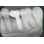 Sulzer Calcitek Omniloc image 2