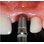 Sargon Dental Implants Internal Connection-Wide image 4