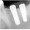 Almitech Implant System Almitech image 9