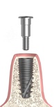 Implantat-Verschlussschraube