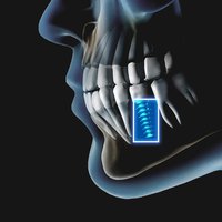 implant-identification-banner.jpg
