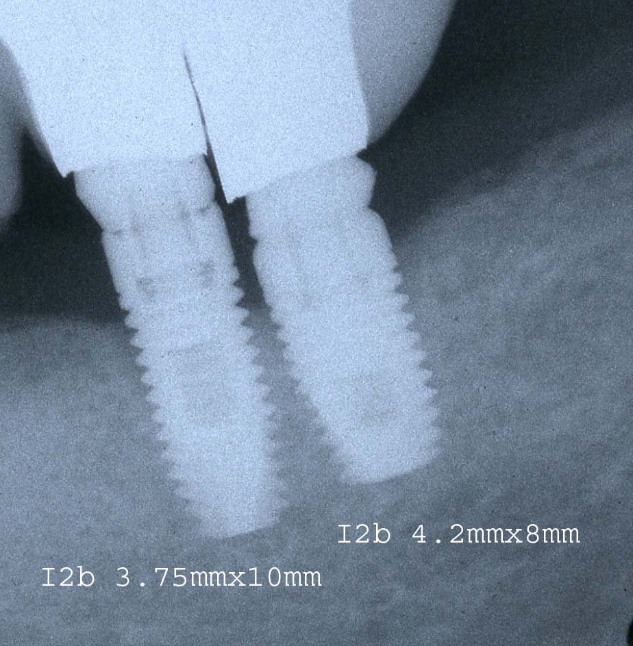 AB Dental Devices I2b Implant dentaire SpotImplant