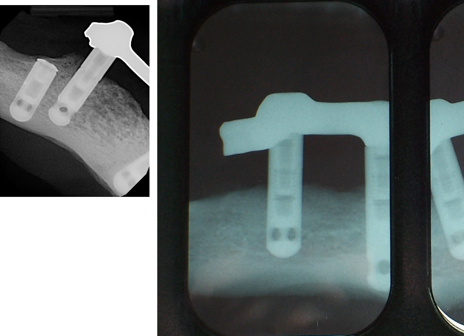 Sulzer Calcitek Integral Dental Implant SpotImplant