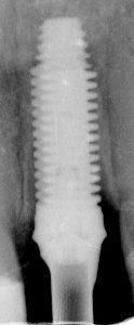 BioHorizons External (Maestro) (Wide) Dental Implant | SpotImplant