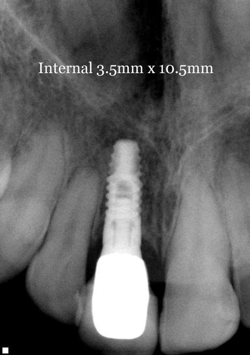 BioHorizons Internal Implante dental | SpotImplant