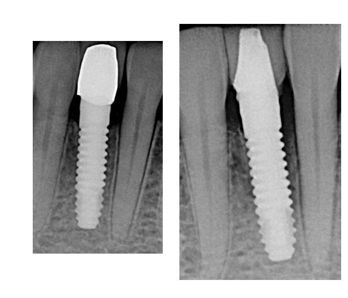 BioHorizons One Piece 3.0 Dental Implant | SpotImplant