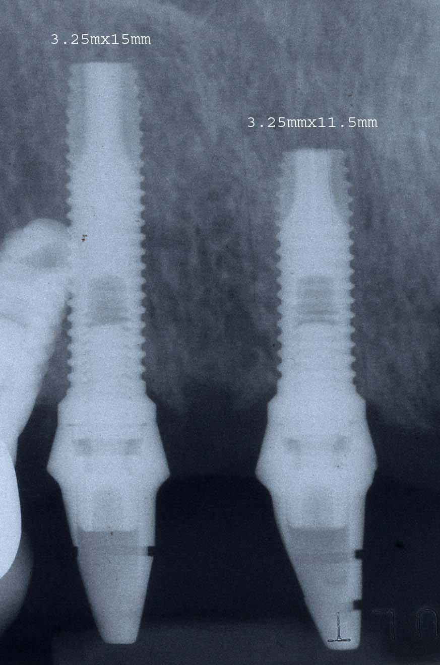 Biomet 3i Parallel Walled Regular Implante Dental Spotimplant