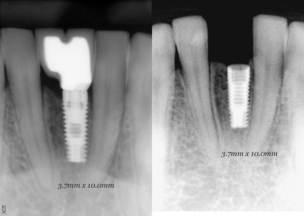 Blue sky bio internal hex implante dental spotimplant
