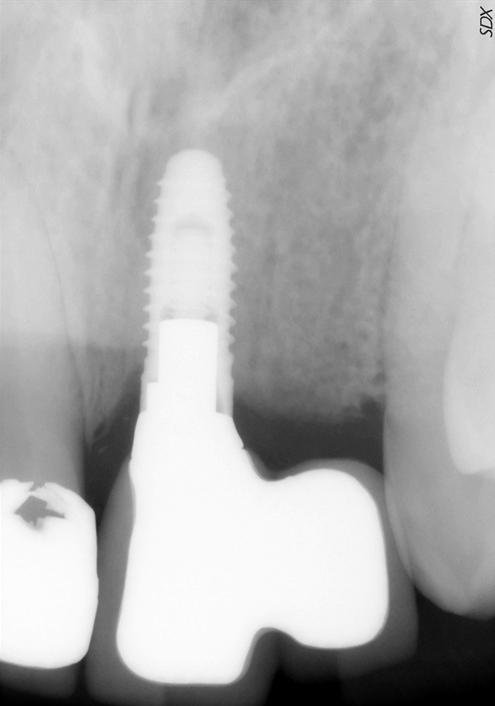 Blue Sky Bio Tri-Lobe Dental Implant | SpotImplant