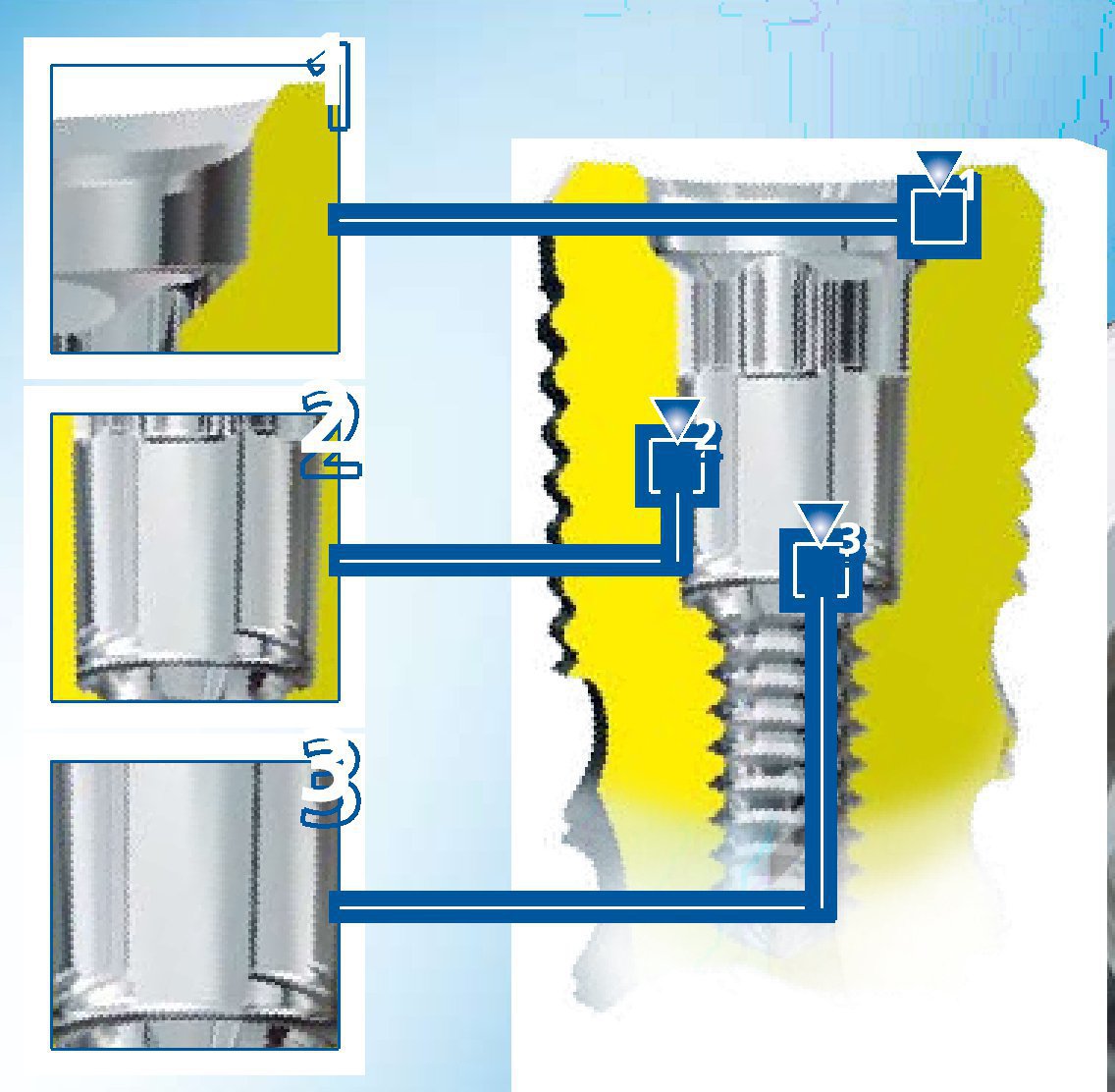 Dentaurum Group tioLogic Dental Implant SpotImplant