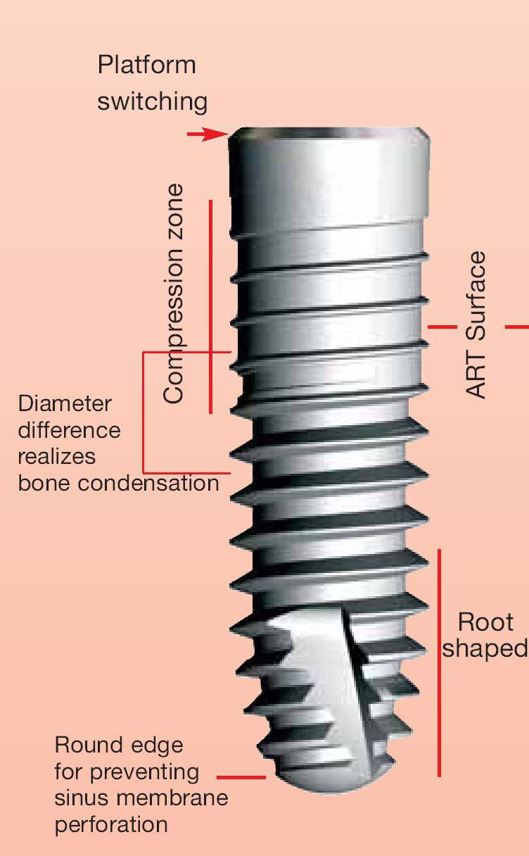 Dyna Dental Helix DC Dental Implant SpotImplant