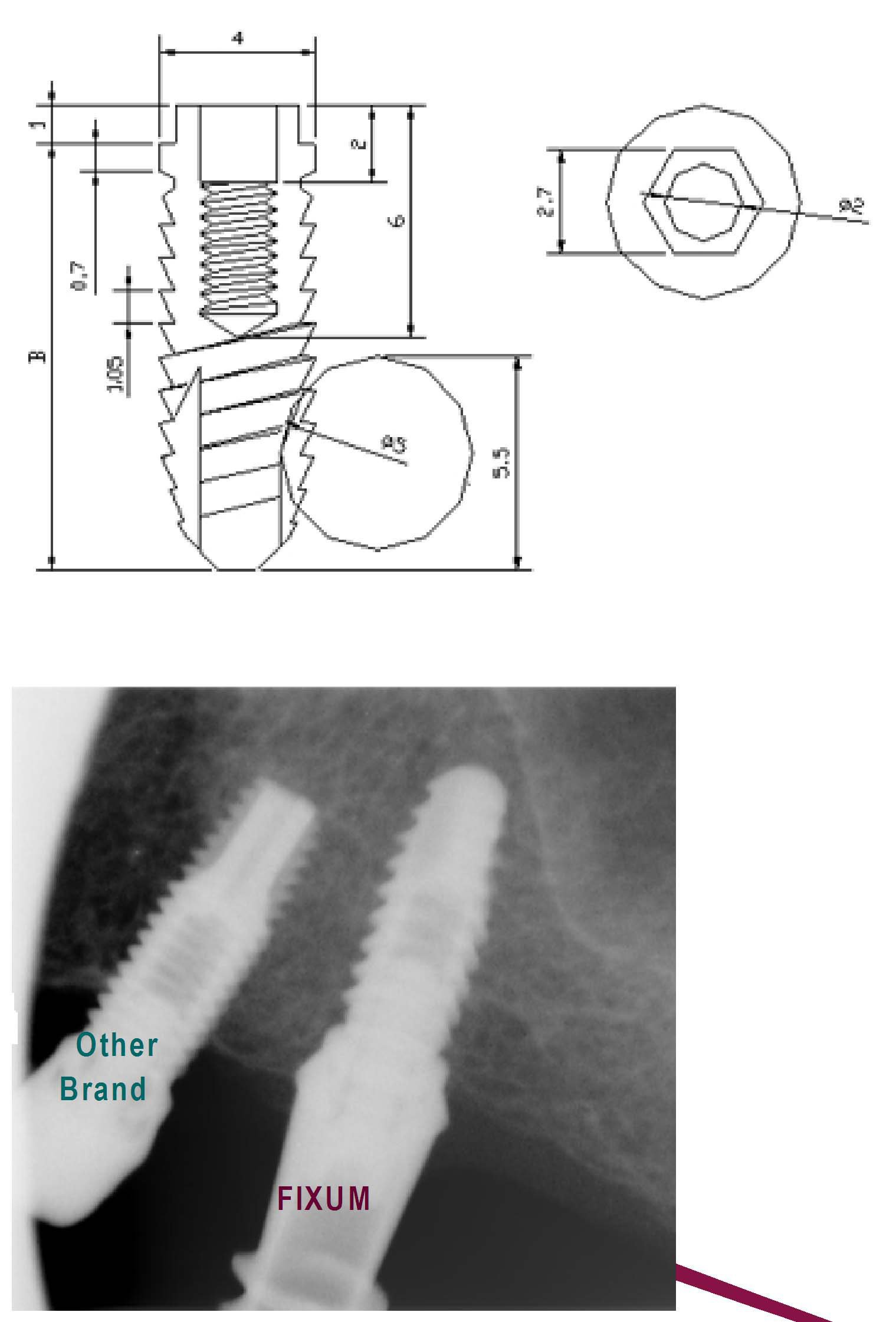 FIXUM Dental Implants Fixum Dental Implant | SpotImplant