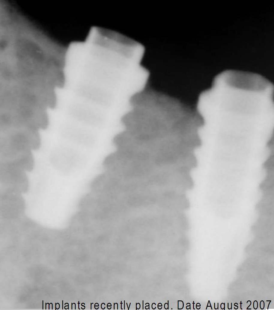 FIXUM Dental Implants Fixum Implant dentaire SpotImplant