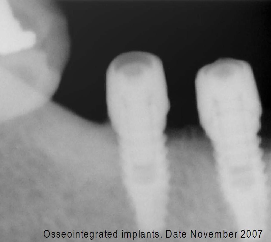 FIXUM Dental Implants Fixum Implant dentaire SpotImplant