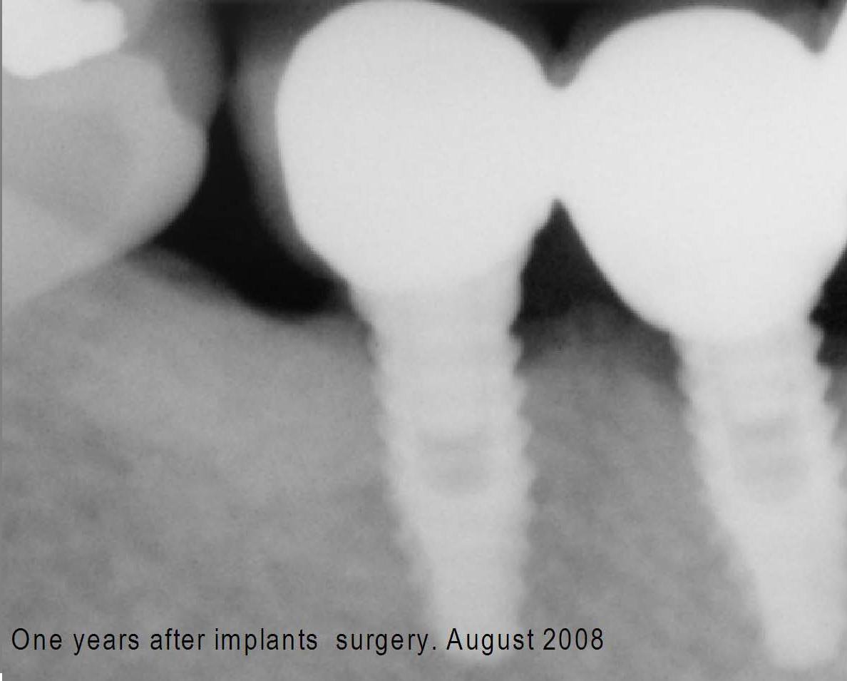 FIXUM Dental Implants Fixum Dental Implant | SpotImplant