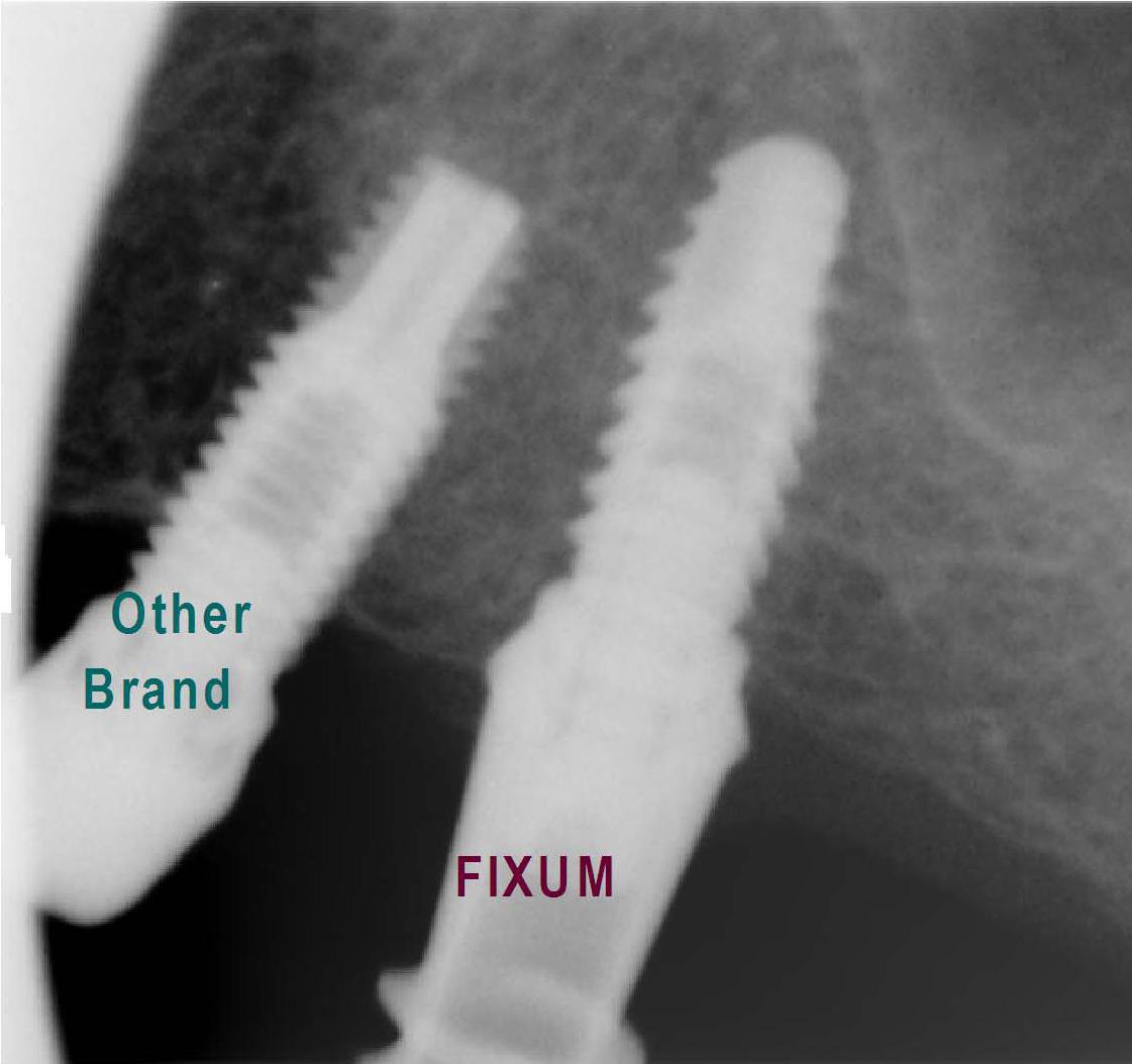 FIXUM Dental Implants Fixum Dental Implant | SpotImplant
