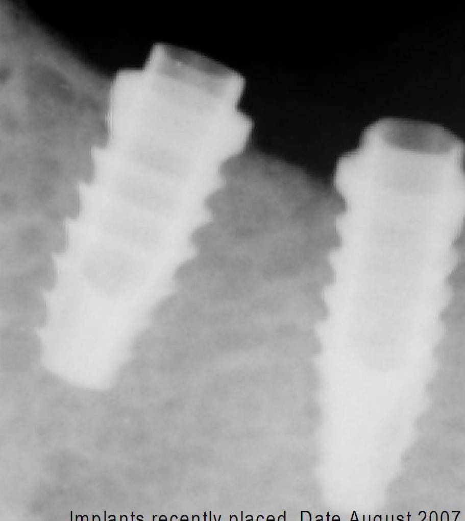FIXUM Dental Implants Fixum Dental Implant | SpotImplant