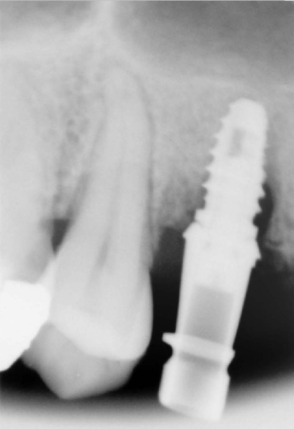 FIXUM Dental Implants Fixum Dental Implant | SpotImplant