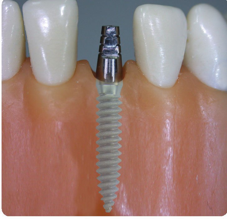 HiTec Implants TRXOP Dental Implant SpotImplant