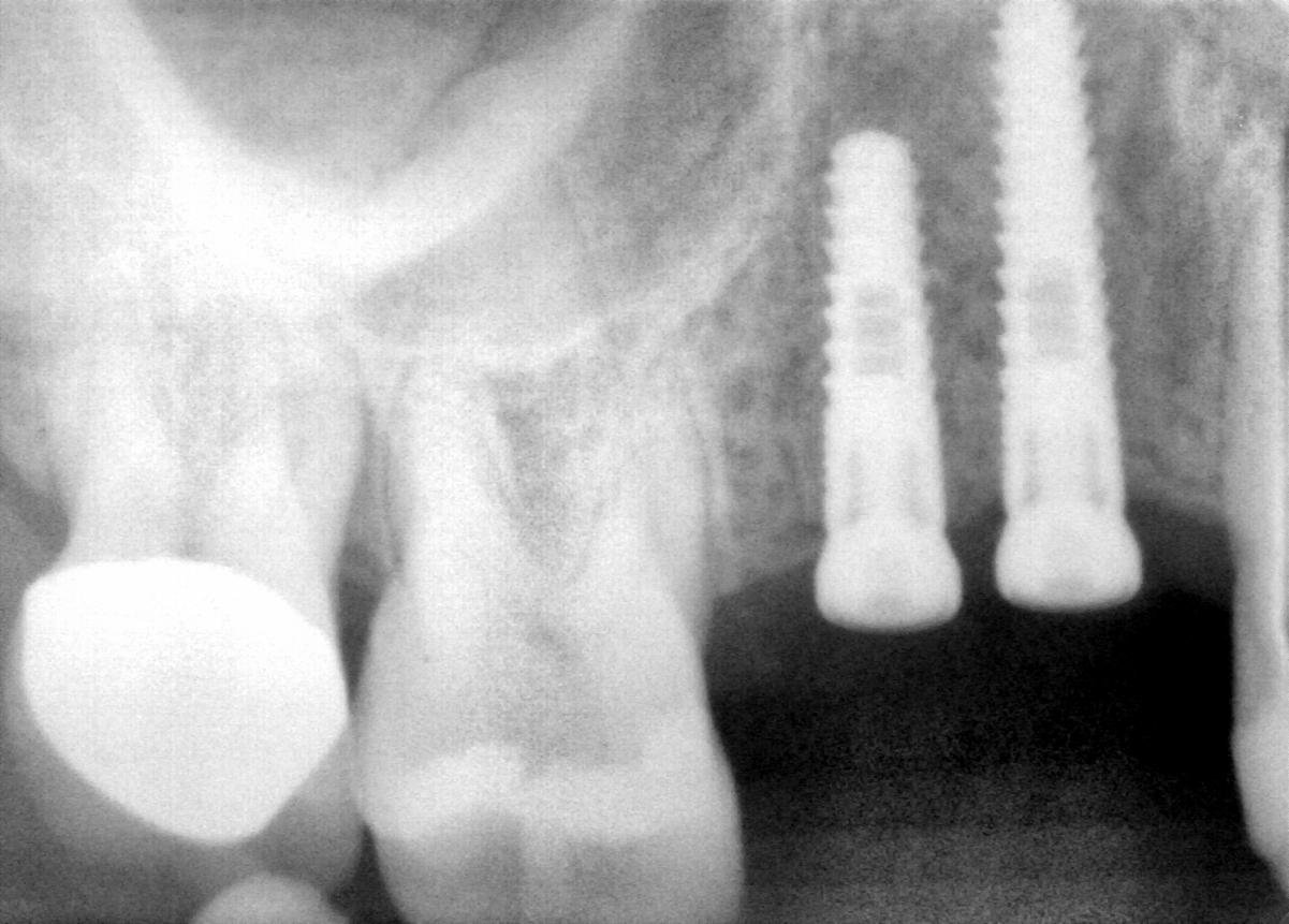 Implant Direct Legacy 2 Implant dentaire SpotImplant