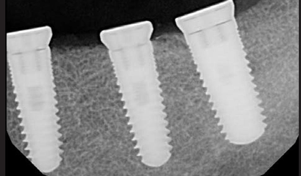 Implant Direct Legacy 2 Implant dentaire SpotImplant