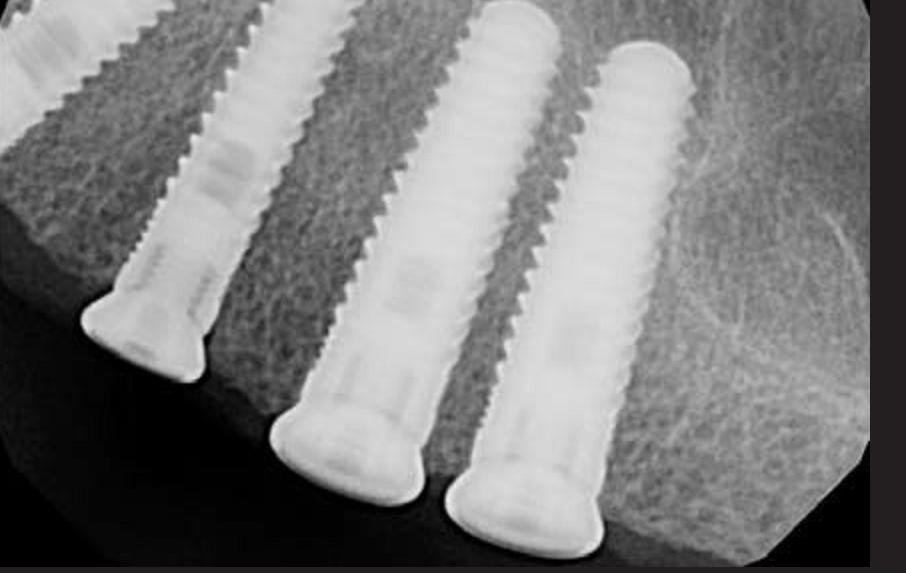 Implant Direct Legacy 2 Implant dentaire SpotImplant