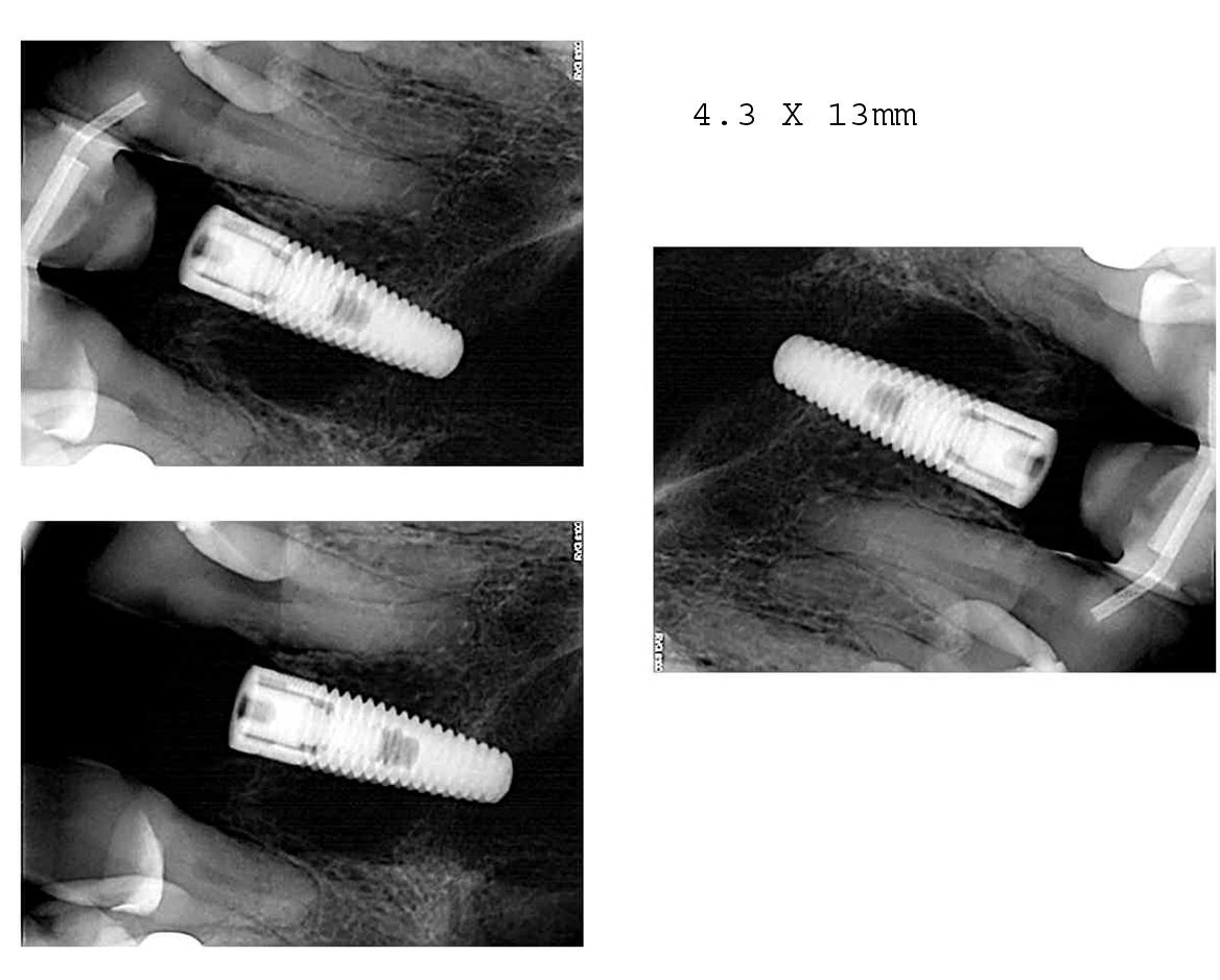 implant-direct-replant-implante-dental-spotimplant