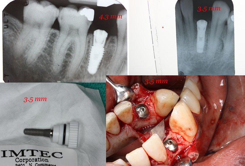 IMTEC Endure CL Implante dental SpotImplant