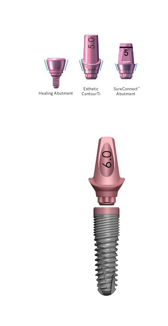 Keystone Dental (Lifecore Biomedical) Genesis Taper Implant dentaire
