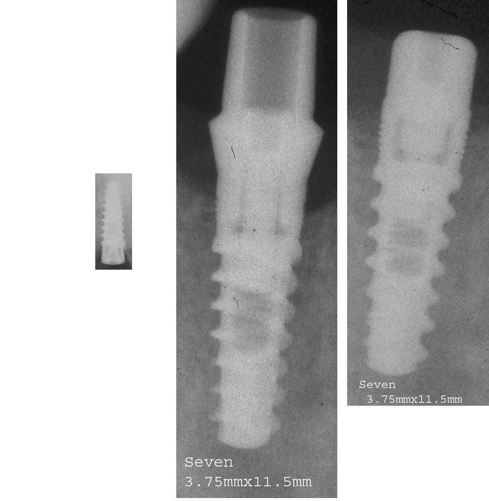 MIS Seven Implante dental SpotImplant