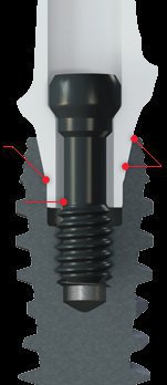 Nobel Biocare NobelActive Implant dentaire | SpotImplant