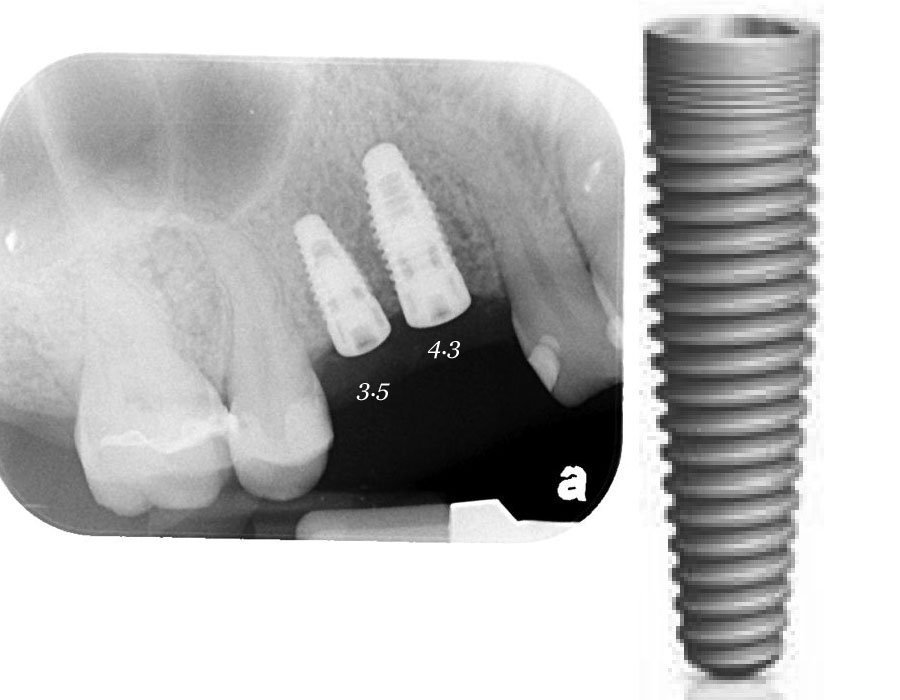 Nobel Biocare NobelReplace Tapered Implante dental SpotImplant