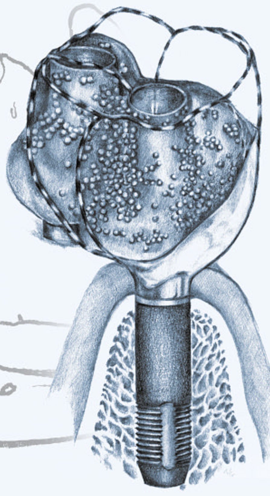 Osfix International Ltd. Oy Osfix Implant dentaire | SpotImplant