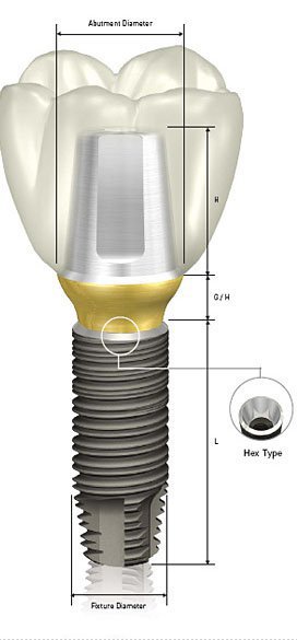 Osstem Implant Company GS II Dental Implant | SpotImplant
