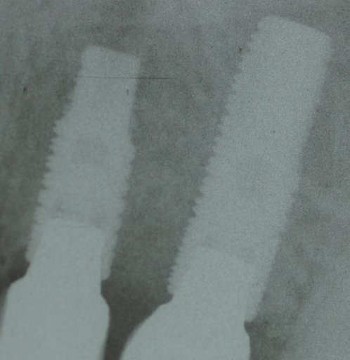 Osstem Implant Company GS II Dental Implant | SpotImplant