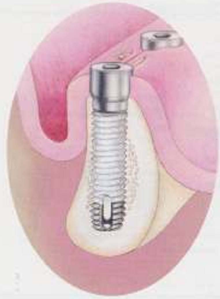 Paragon TaperLock Screw Implante dental SpotImplant