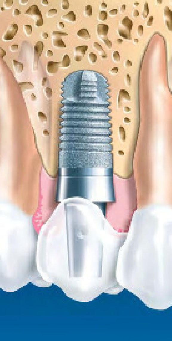 Schütz Dental Impla Benner Screw Dental Implant | SpotImplant