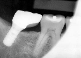 Straumann Standard Dental Implant | SpotImplant