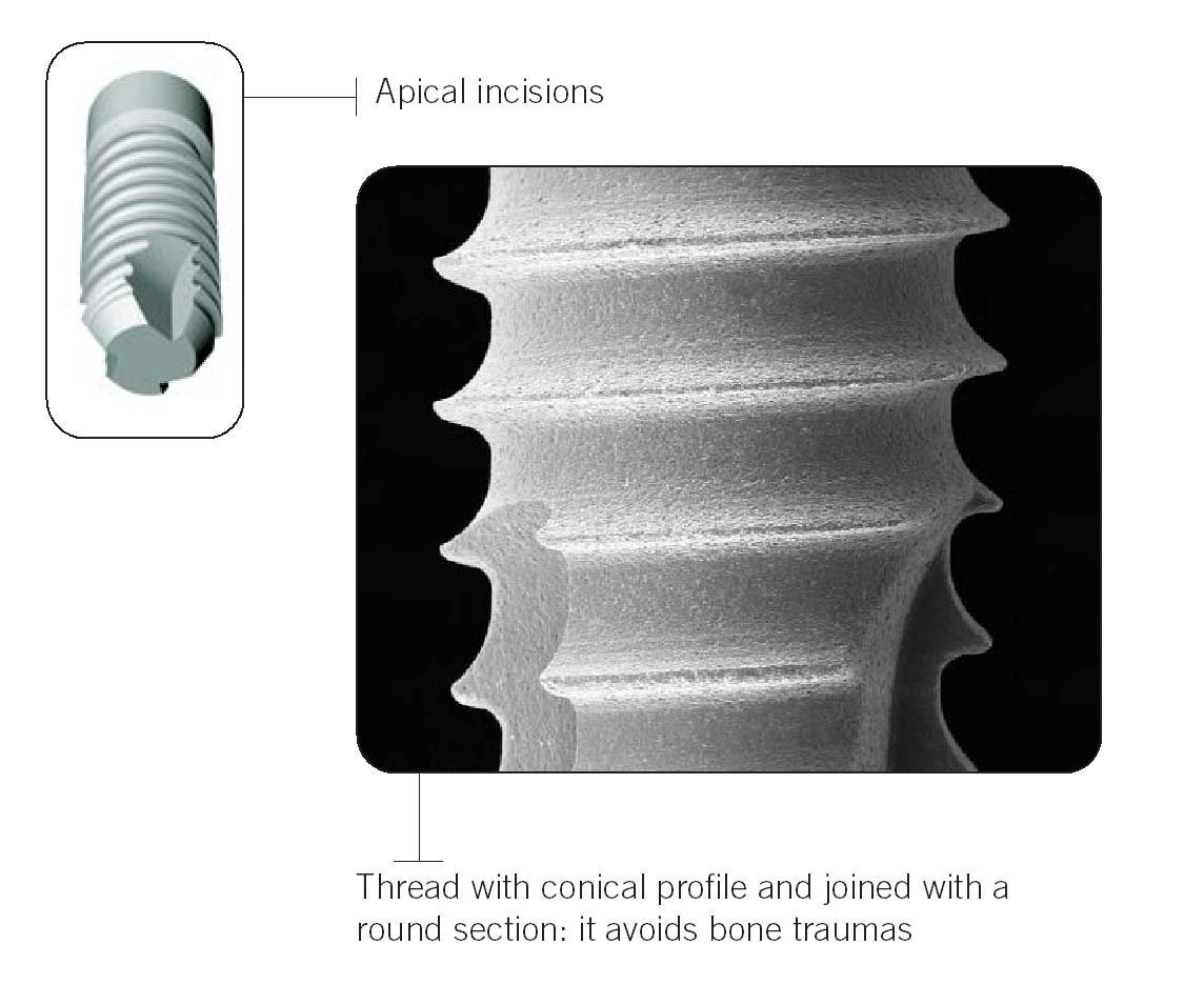 Sweden & Martina Premium One Dental Implant SpotImplant