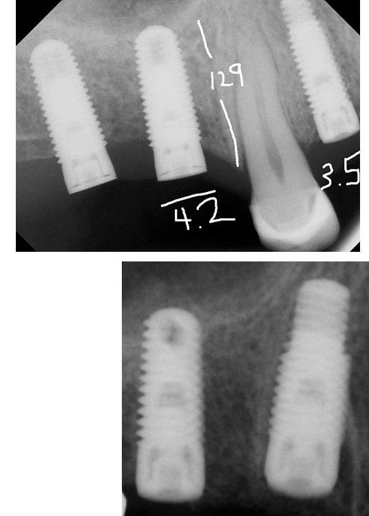 ZimmerBiomet Tapered ScrewVent (TSV) Implant dentaire SpotImplant