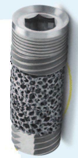 Zimmer-Biomet Trabecular Metal Implante dental | SpotImplant